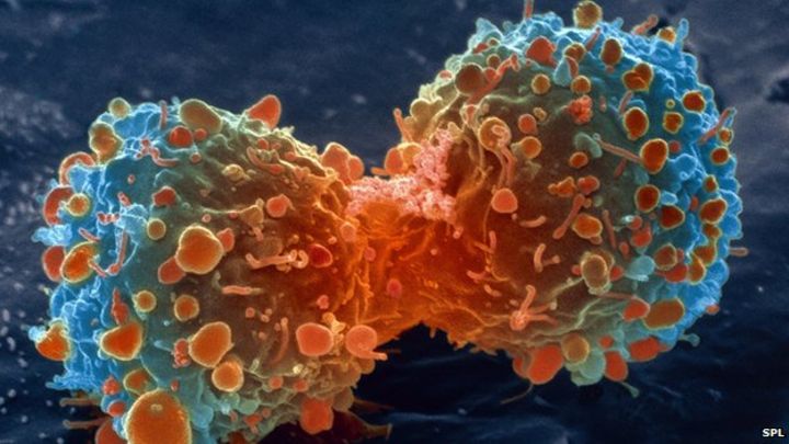 https://ichef-1.bbci.co.uk/news/720/media/images/83307000/jpg/_83307904_m1320644-lung_cancer_cell_division,_sem-spl.jpg