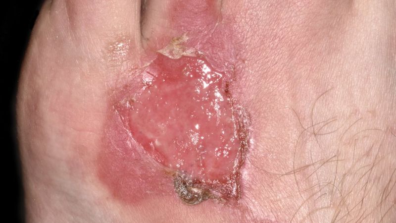 heridas en el glande imagenes heridas en el glande imagenes
