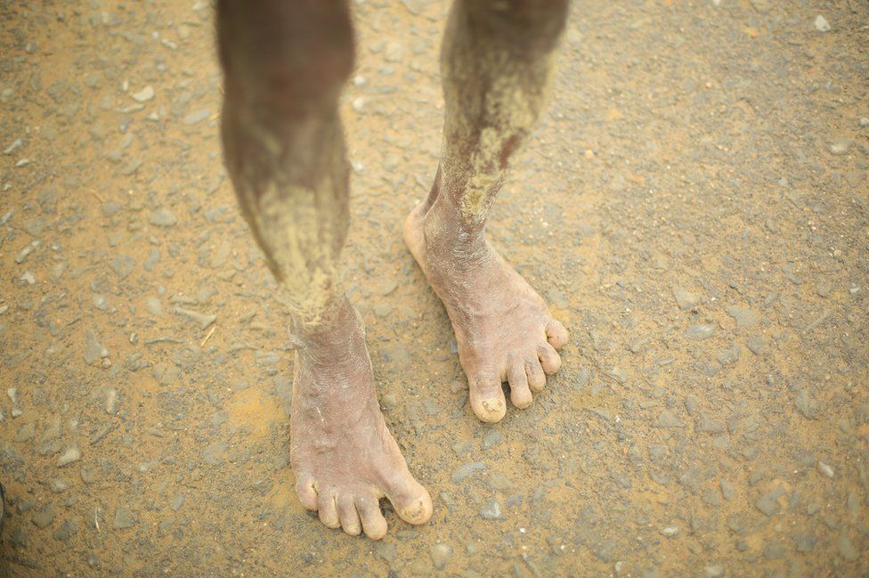 The tired, mud-coated legs of a fleeing Rohingya person