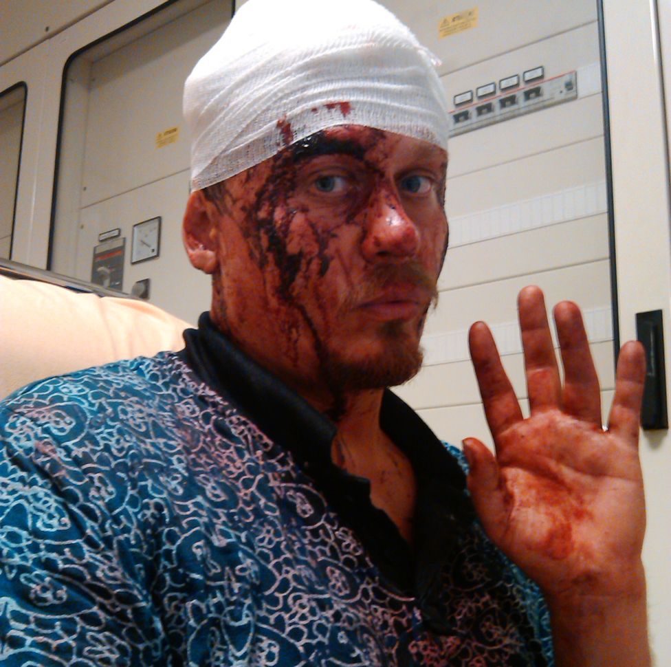 Воротников в больнице после драки с итальянскими анархистами. Июнь 2014, Венеция
