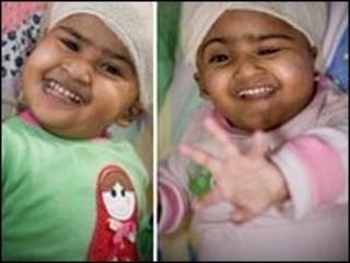 Trishna dan Krishna adalah bayi kembar siam sebelum operasi pemisahan.