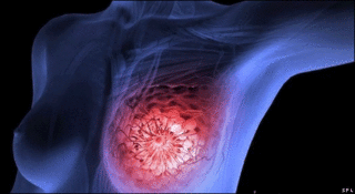 Tumor de mama (SPL)