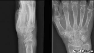 Raio-x de vítima de osteoporose (Wikimedia Commons)