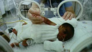 Bebê prematuro em incubadora
