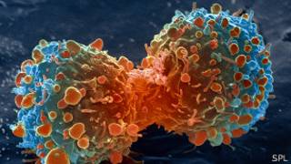 Ilustración del cáncer de pulmón