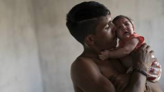 Padre sostiene en brazos a bebé con microcefalia