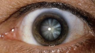 Globo ocular