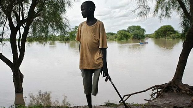 Joven con una pierna amputada a causa de la picadura de una serpiente venenosa. 