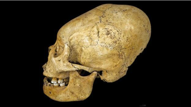 Cráneo deformado de Perú