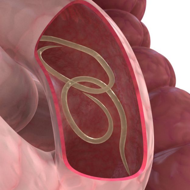 Lombirz intestinal