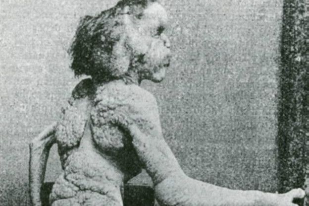 John Merrick