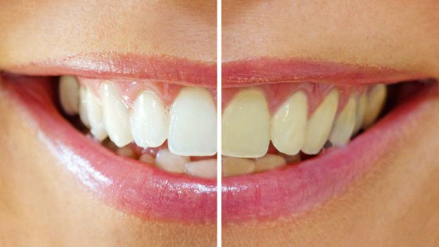Blanqueamiento dental