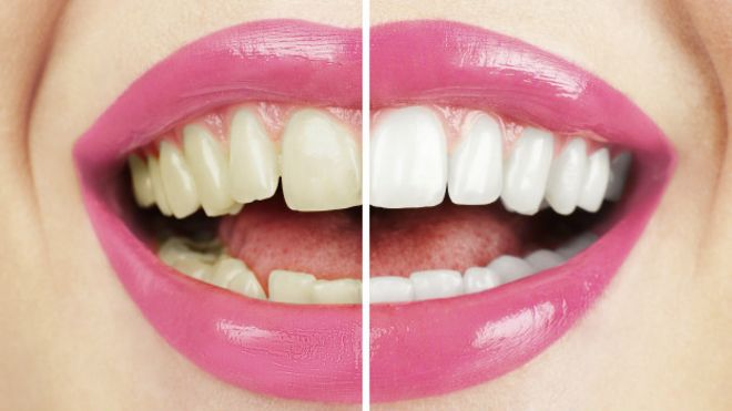 Comparación de dientes blanqueados