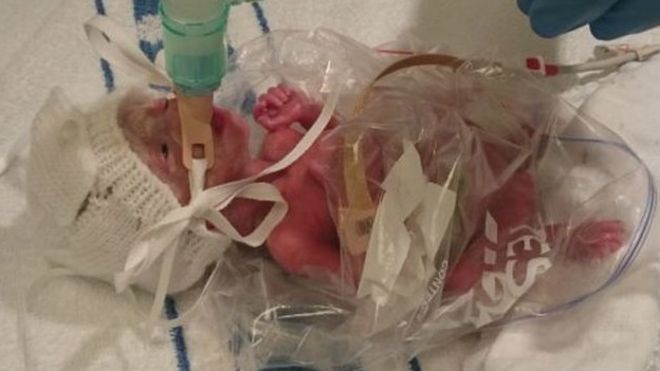Bebé prematuro en bolsa de sándwich