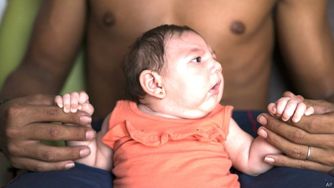 Luiza, bebé que nació con microcefalia en Pernambuco, Brasil